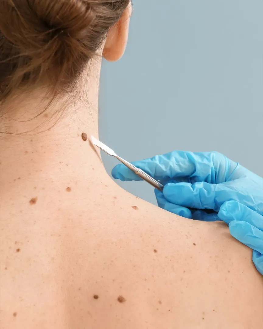 Skin Lesion Removal