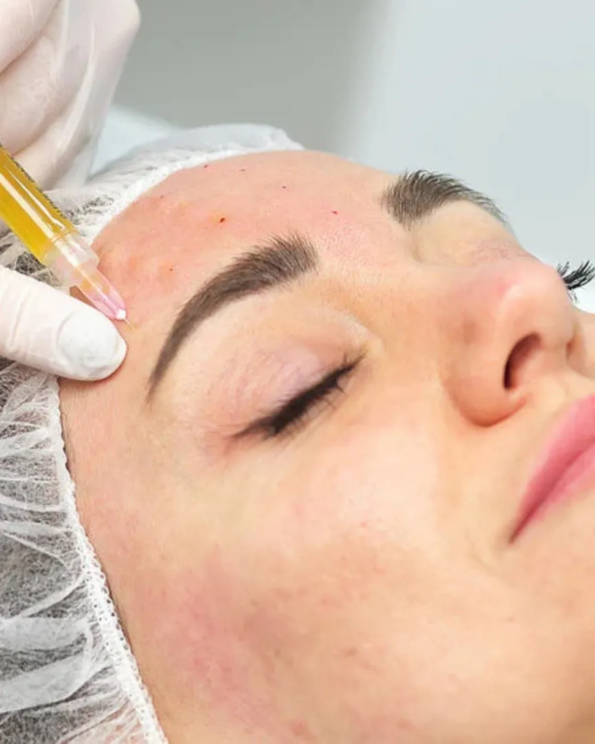 PRP (Platelet-Rich Plasma) Facial Rejuvenation