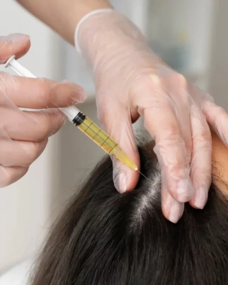 PRP (Platelet-Rich Plasma) Hair Restoration